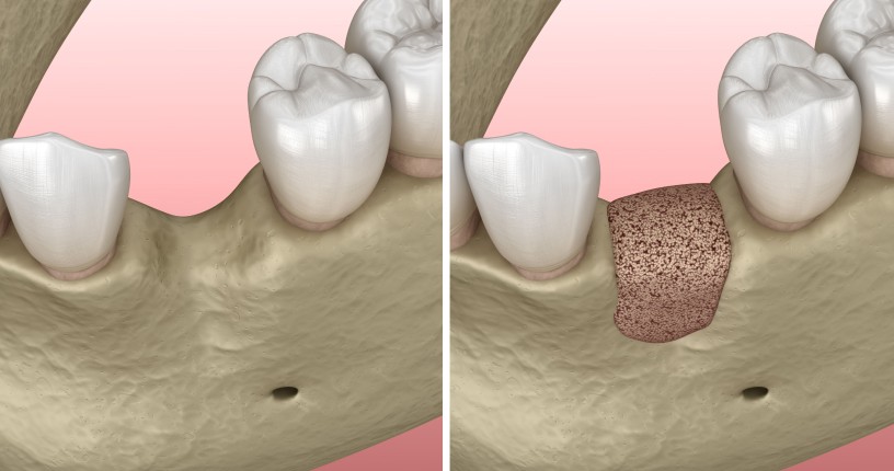 Les greffes osseuses au cabinet dentaire des drs Herbet & Wagner